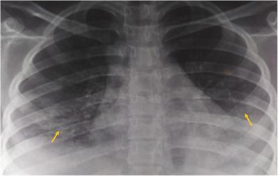 Case Report: Crosstalk between systemic lupus erythematosus and sickle cell syndromes—two cases from eastern India